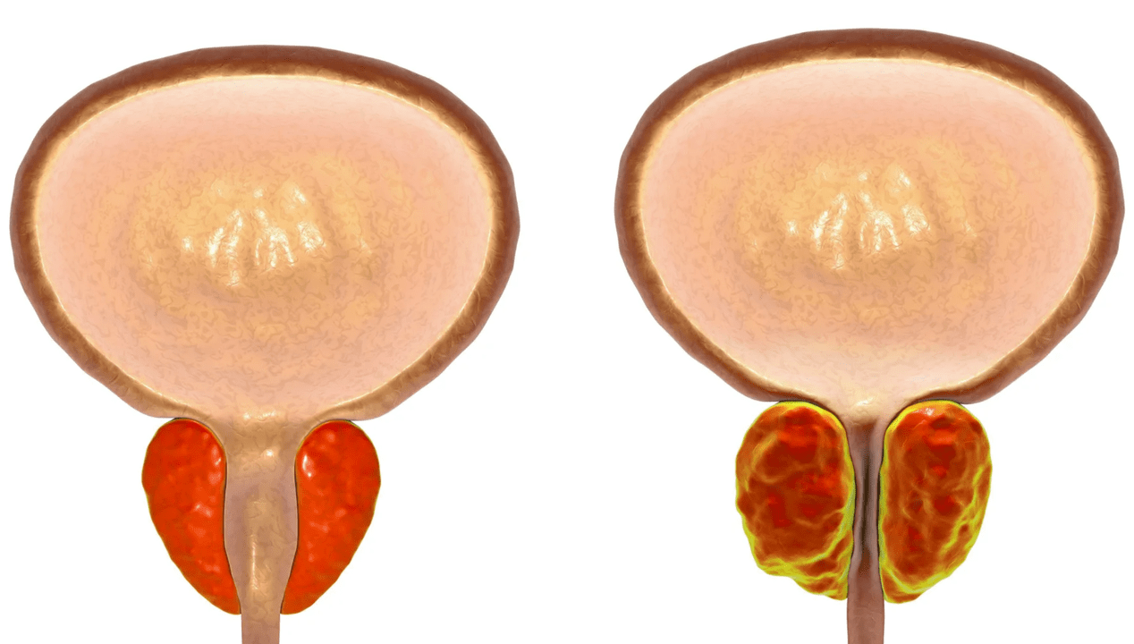 Qu’est-ce que la prostatite 