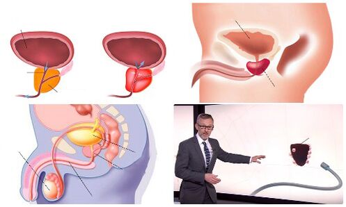 prostate saine et malade